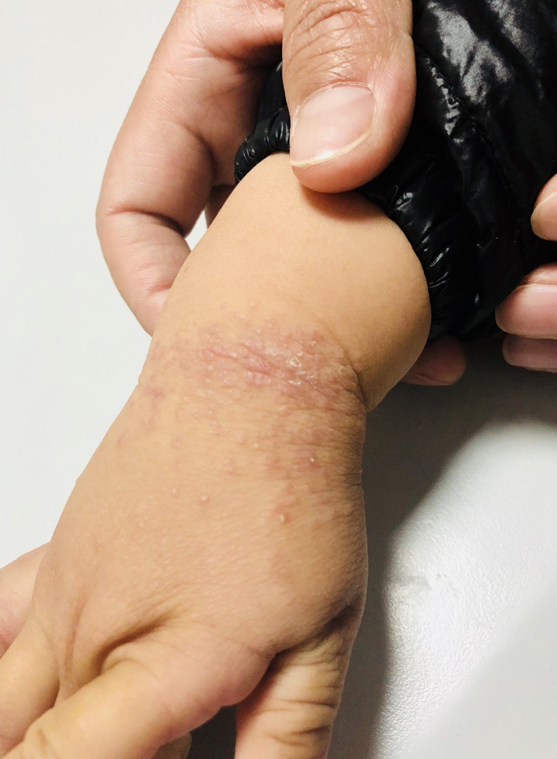 记住孩子手上这种皮疹 不是湿疹 过敏 疾病介绍 治疗方法 预防 好大夫在线 记住孩子手上这种皮疹 不是湿疹 过敏 疾病介绍 治疗方法 预防 好大夫在线