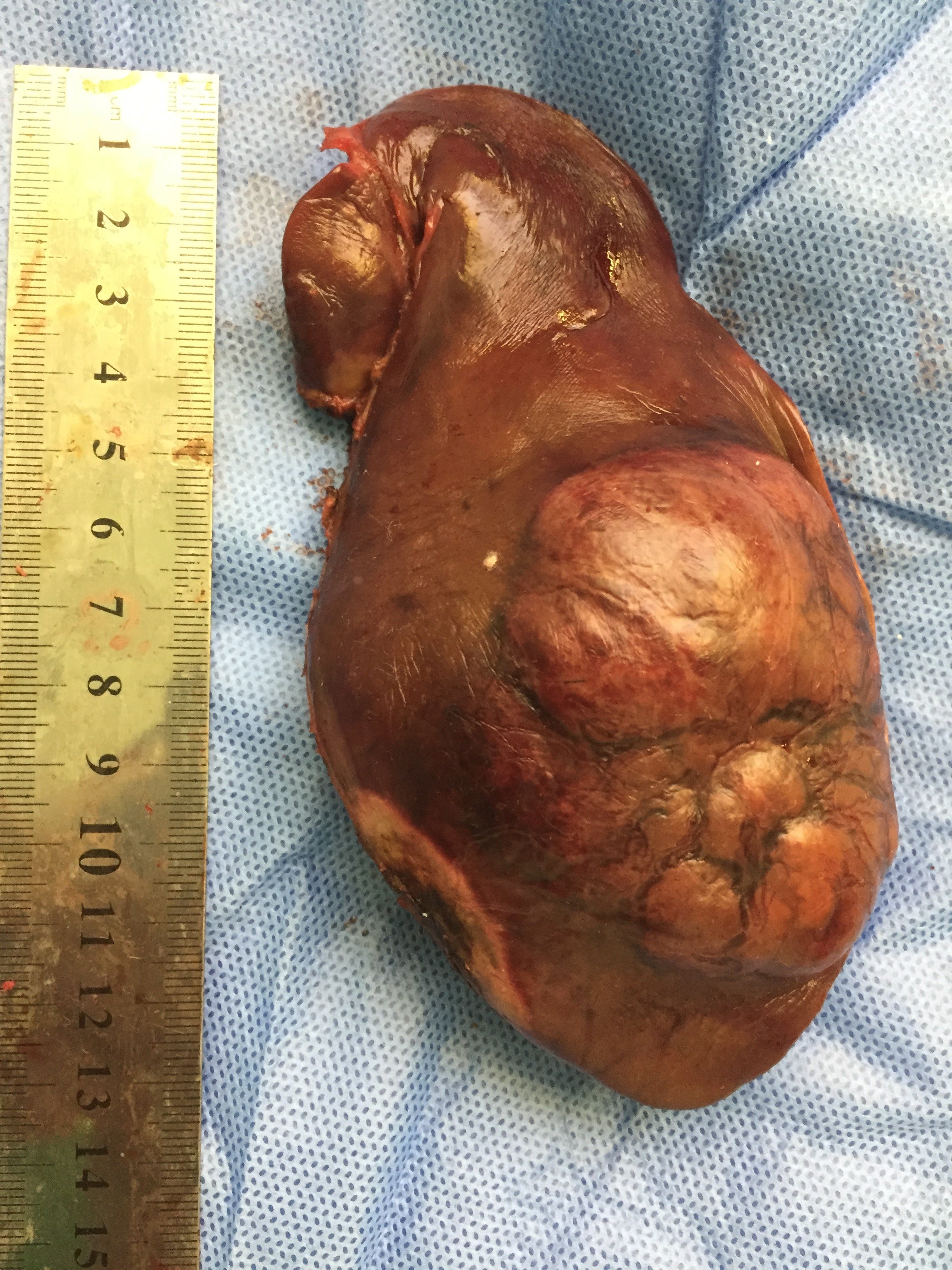 经腹腔镜肝肿瘤切除,微创美观且恢复快速 - 好大夫在线