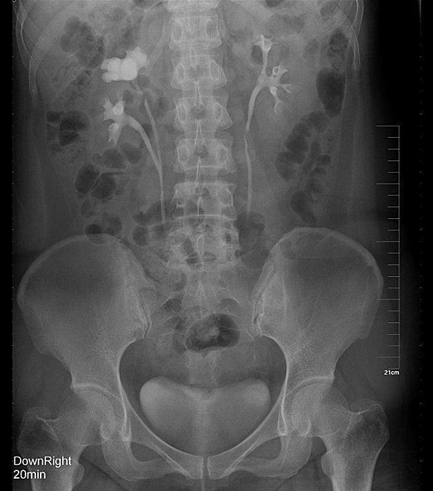 肾输尿管先天性畸形治疗的最新进展