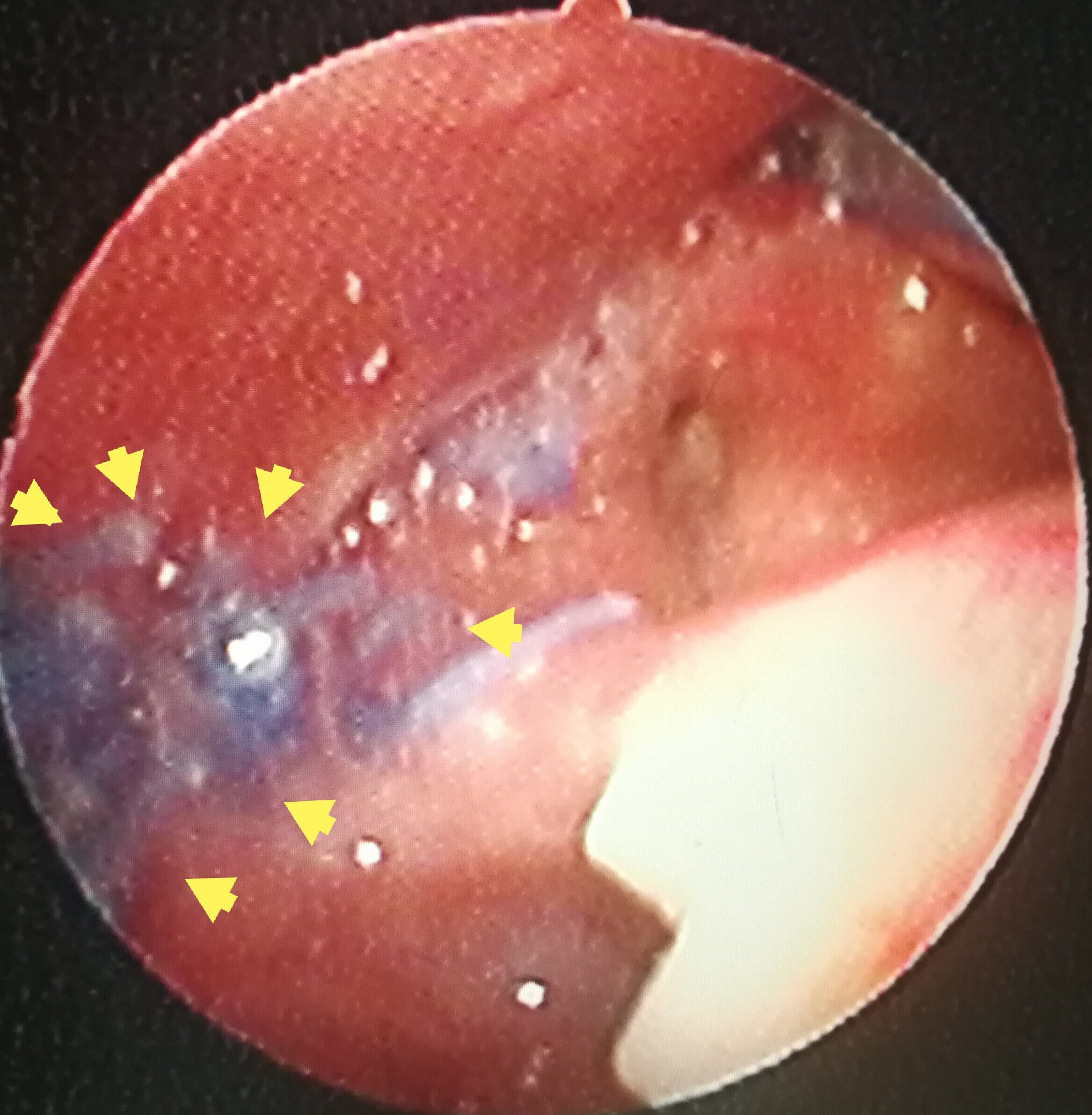 下咽癌术后七天 - 好大夫在线
