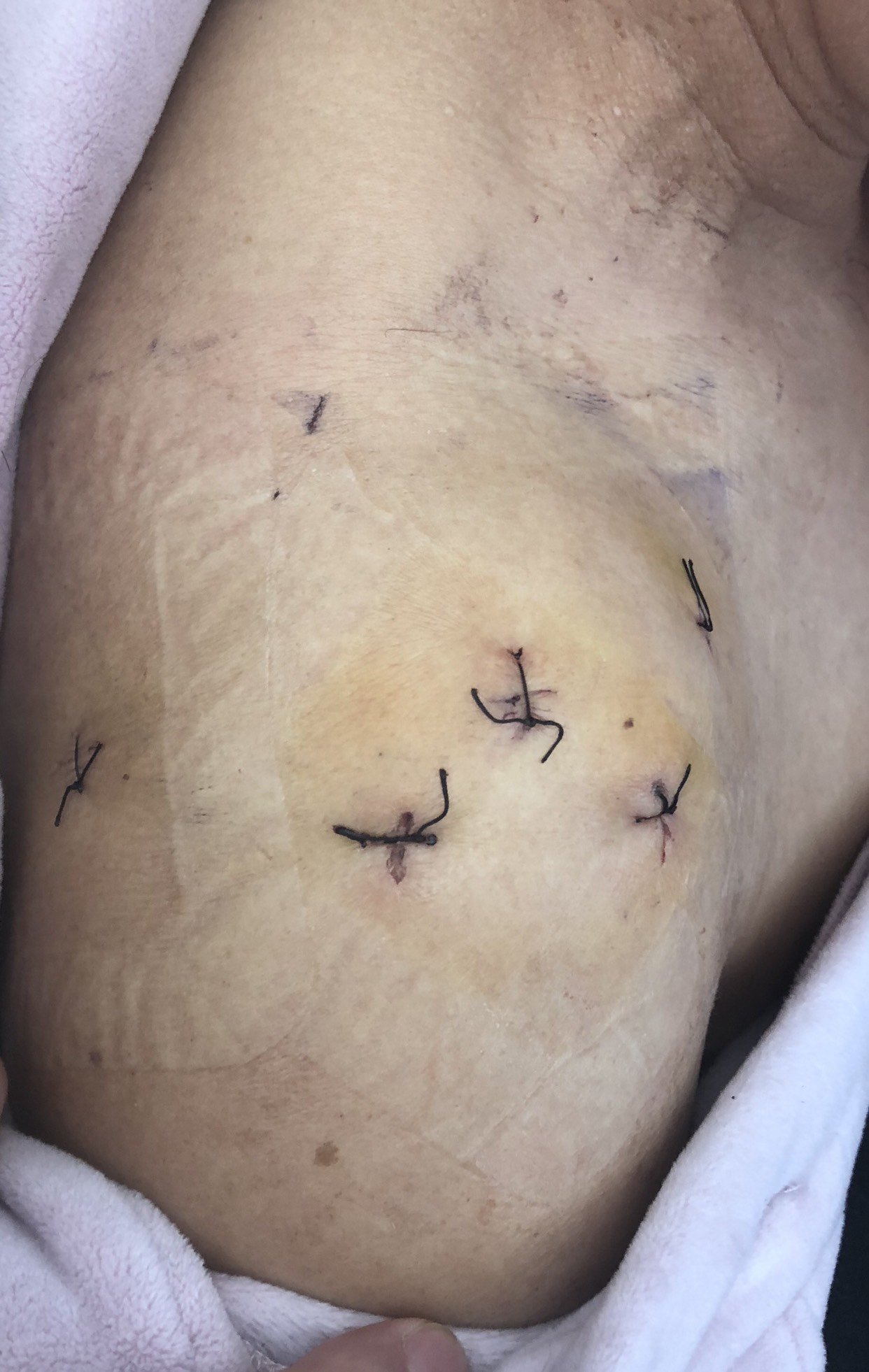 肩钙化性肌腱炎的手术治疗 - 好大夫在线