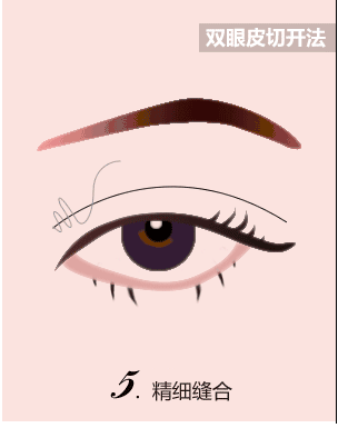 一张图告诉大家双眼皮+开眼角手术的操作原理