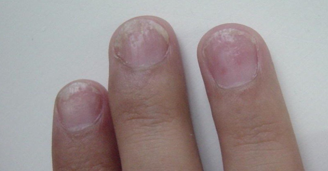 甲病:"灰指甲"有可能是"牛皮癣" - 好大夫在线