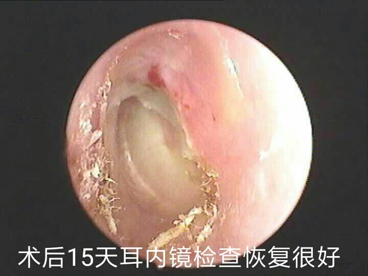 外耳道肿瘤一例! 
