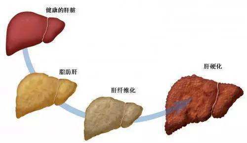 症状 脂肪 肝