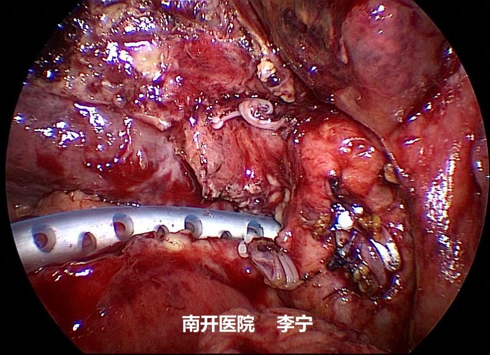 胆石症微创技术,策略及理念的新挑战 - 好大夫在线