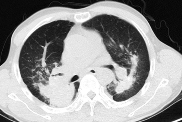 晚期尘肺病能做肺移植吗?