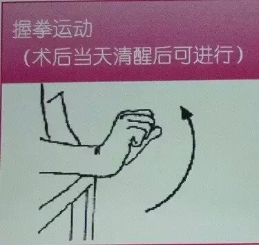 乳腺癌术后早期功能锻炼