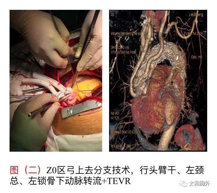 太和医院胸心大血管外科专注于微创理念,长期开展主动脉夹层外科治疗