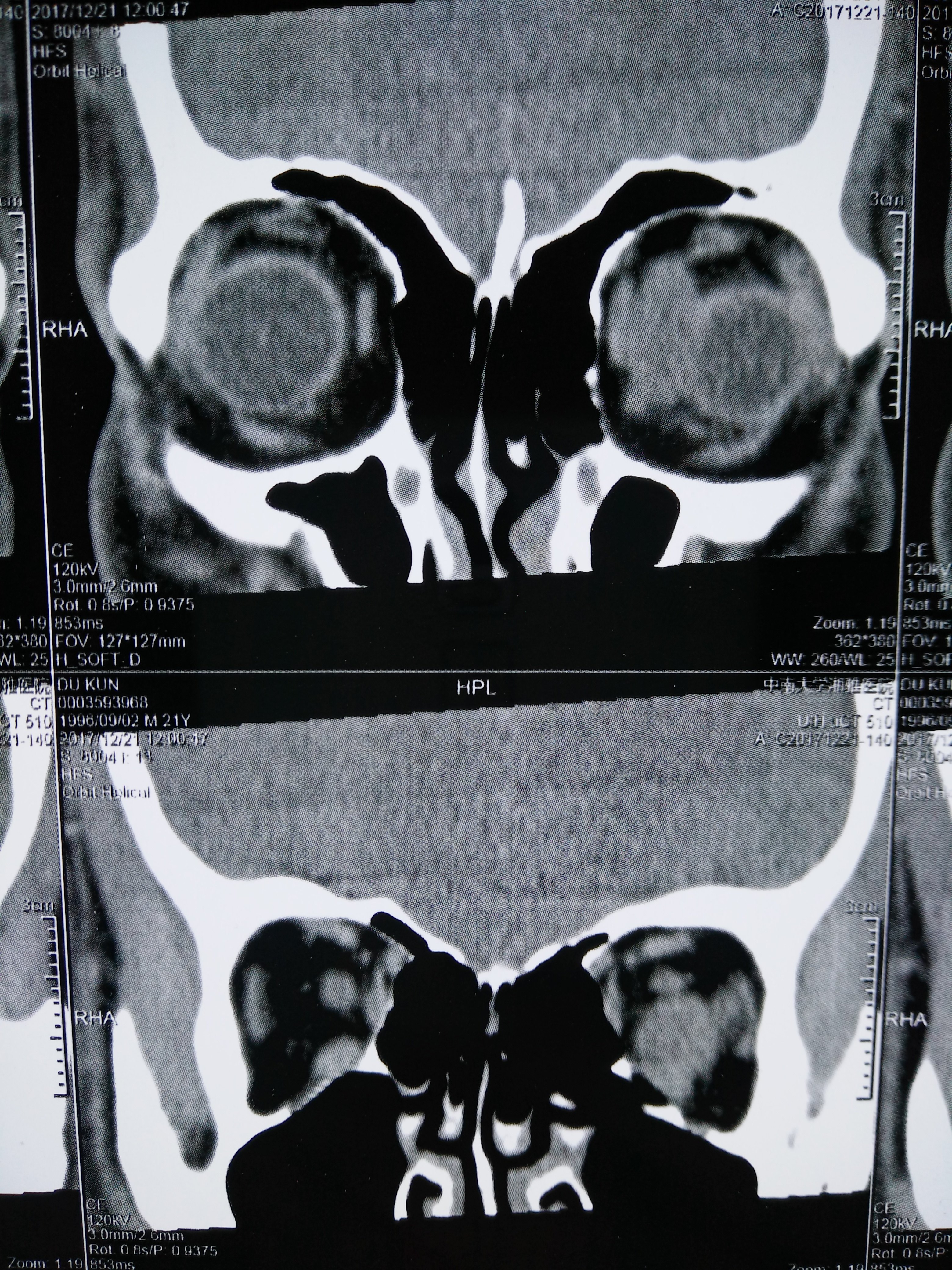 眼眶ct平掃.門診病歷.手術前正面照.入院診斷:眼眶腫物左眼.