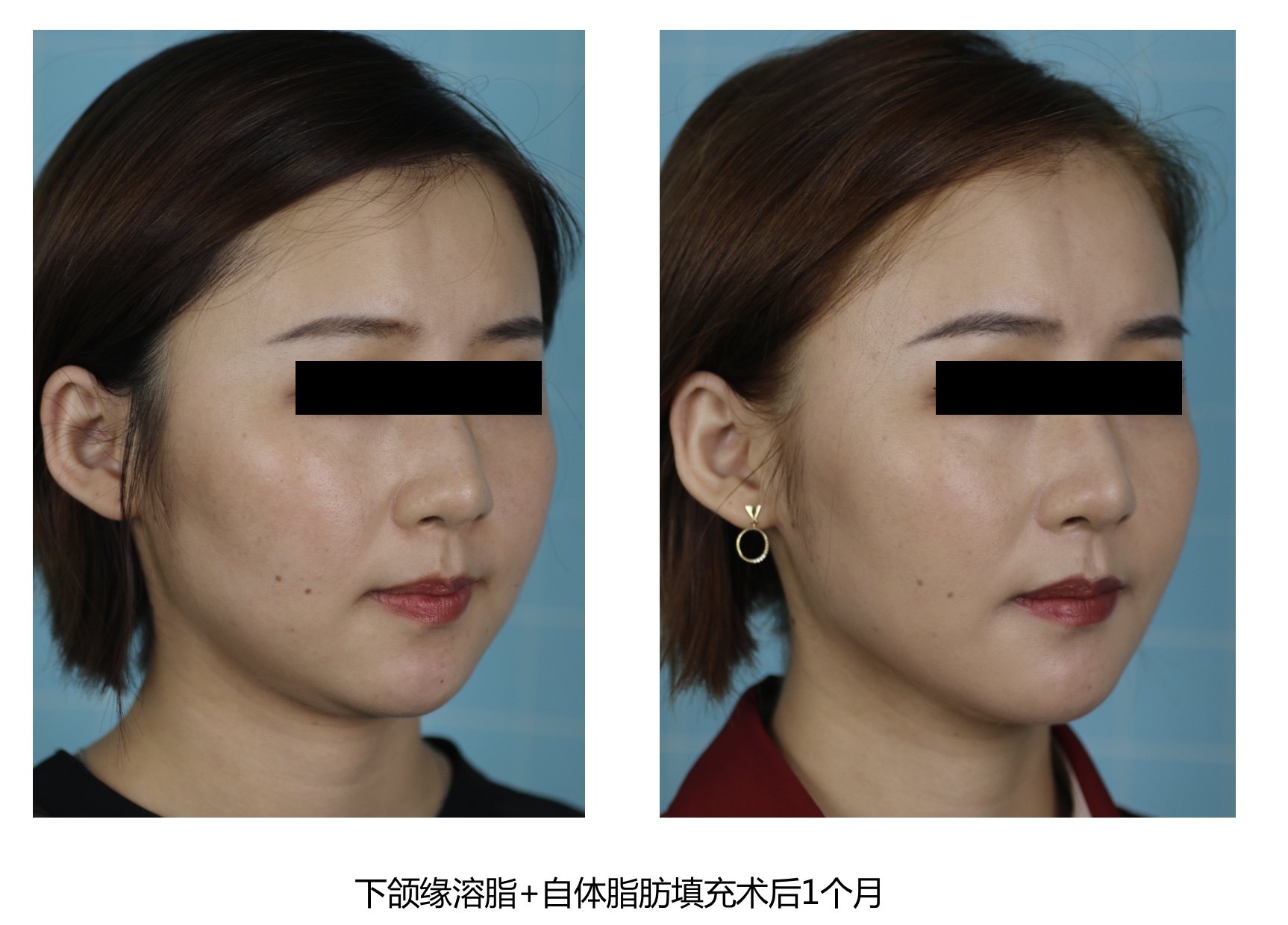 下面部精确吸脂即刻自体脂肪隆下颌