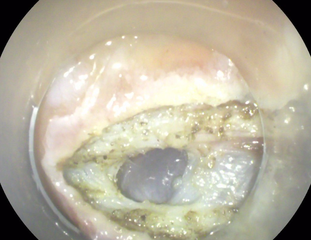 经口胃镜下肝囊肿开窗术 - 好大夫在线
