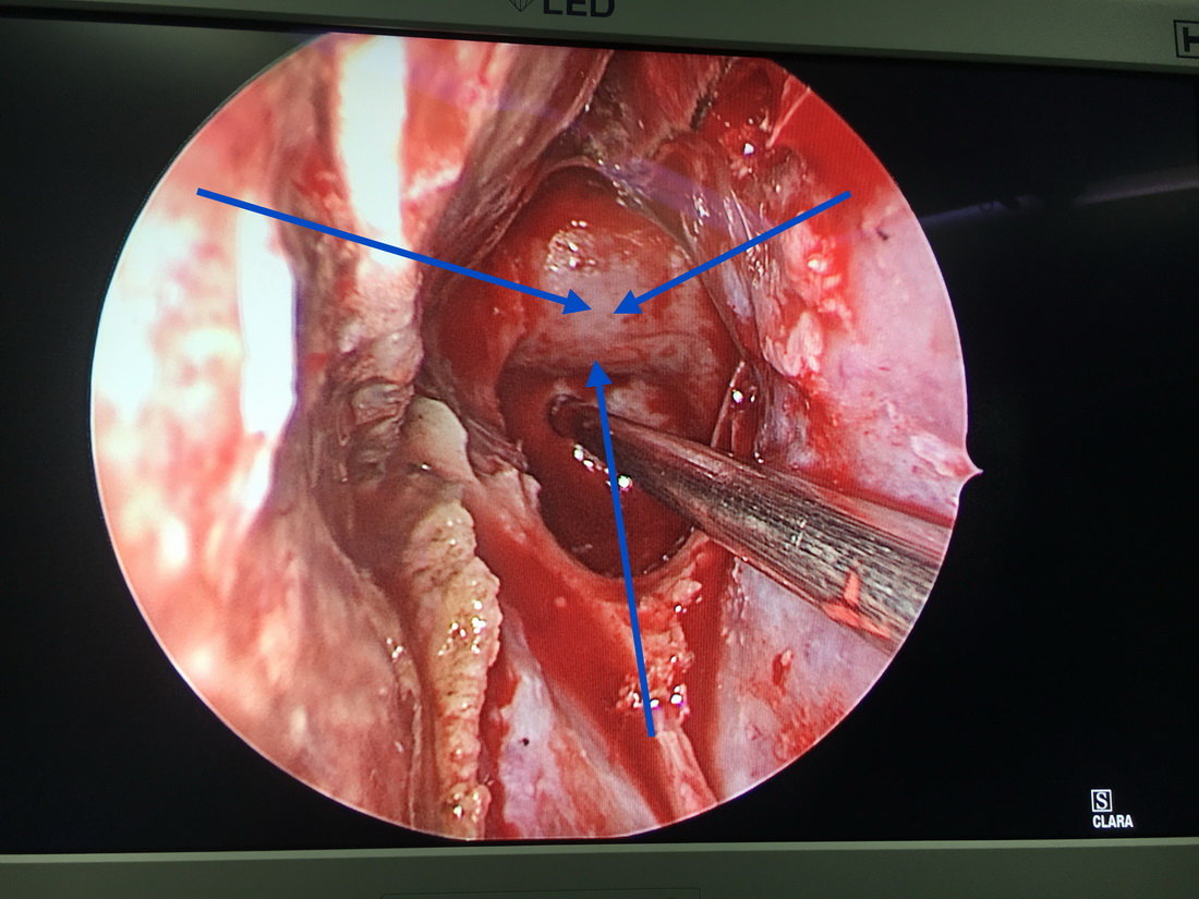 神经内镜下全切除垂体大腺瘤一例