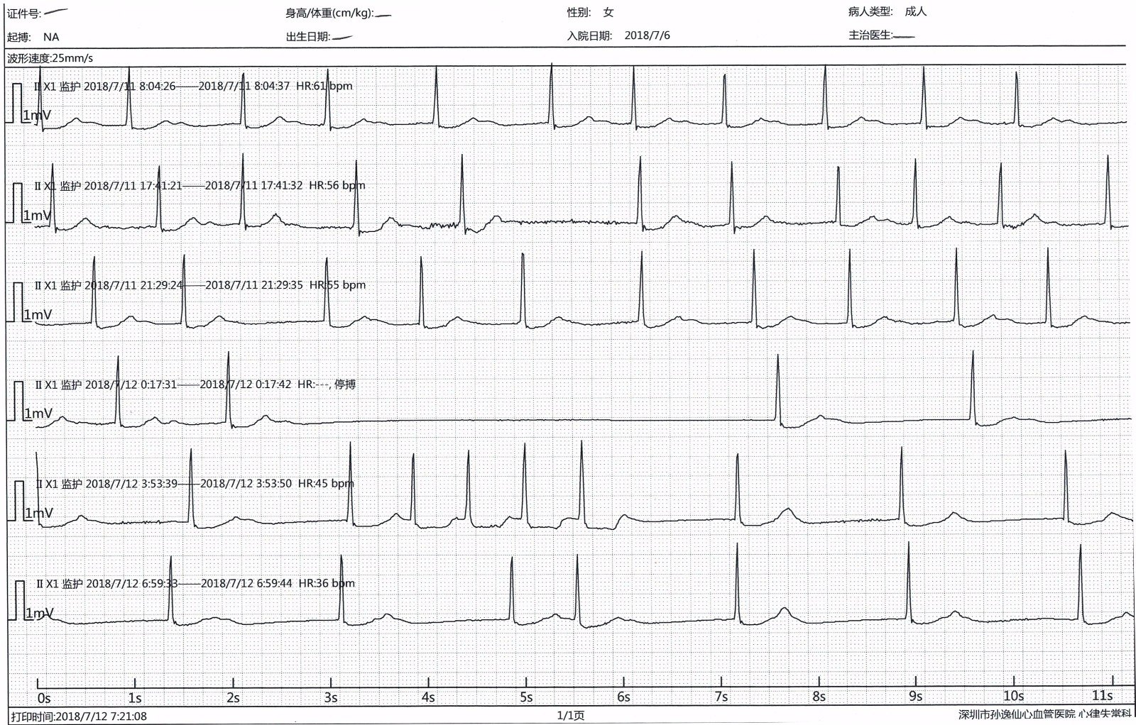 缓慢性心律失常患者的福音——永久性希氏束起搏