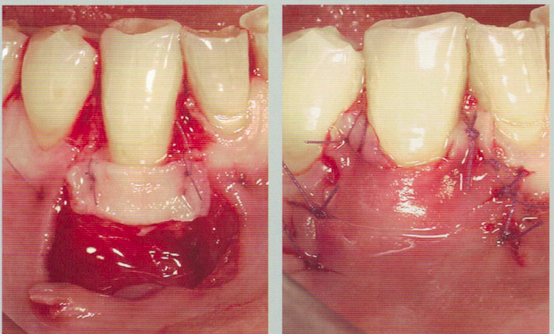 什么样的牙龈退缩能够通过手术治疗恢复正常