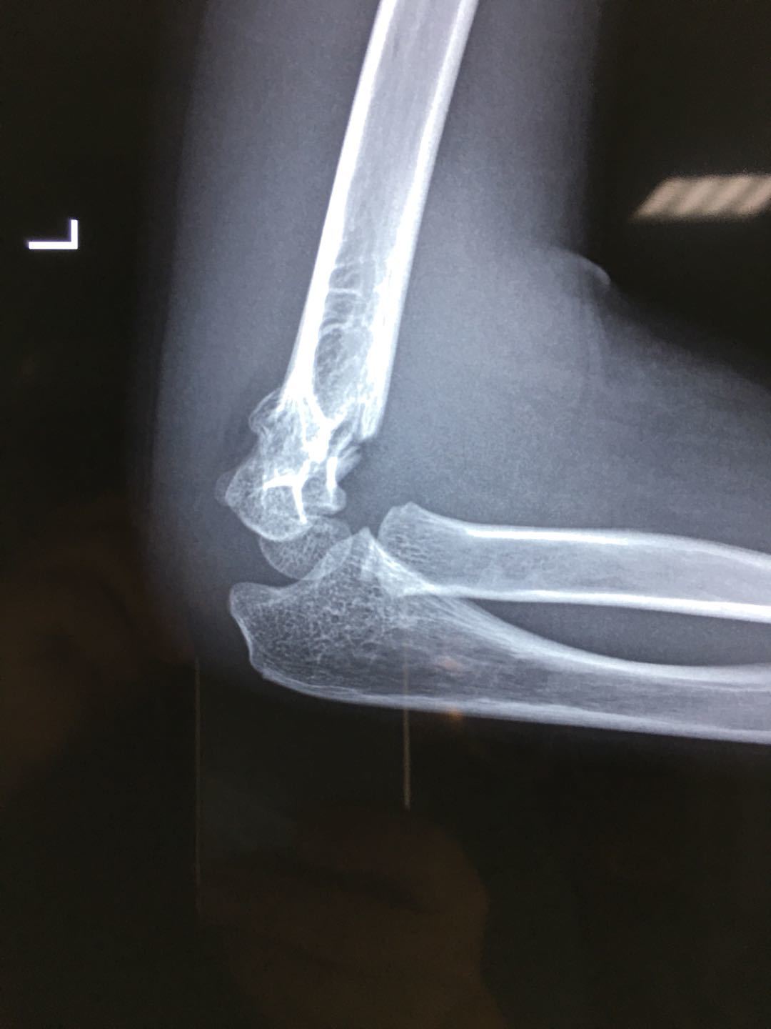 儿童右肱骨髁上骨折图片