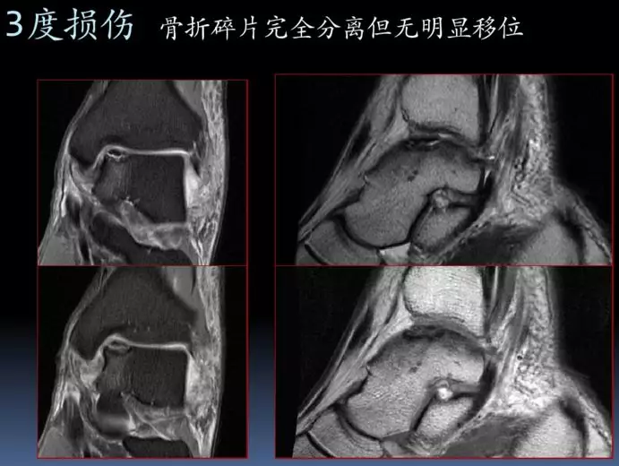 5度: 骨軟骨骨折,累計距骨床4度:骨軟骨碎片完全分離且有移位3度:骨