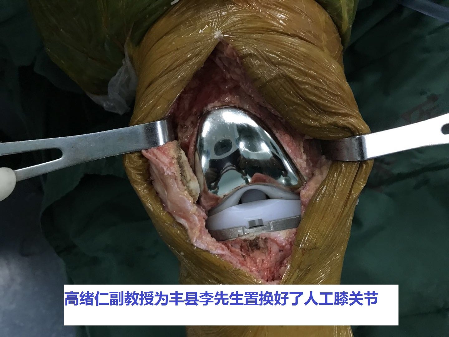 丰县宋楼70岁老李徐州二院骨科人工膝关节置换手术过程照片