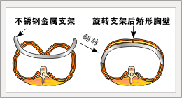 治疗漏斗胸,经典的矫形术(ravitch术式)需切除部分畸形的肋软骨和胸骨