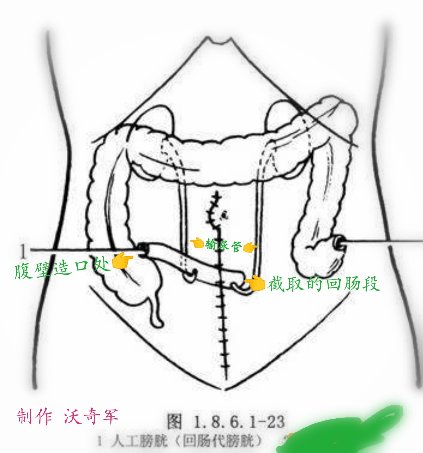 回肠膀胱术示意图图片