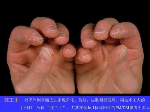 如何判断我是具有自身免疫"色彩"间质性肺炎?