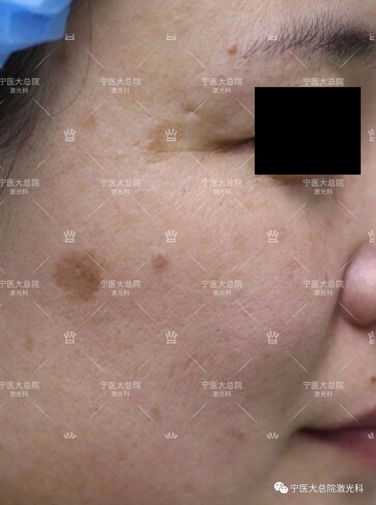 祛除面部晒斑,咖啡斑,老年斑,黄褐斑,雀斑,黑色素痣,扁平疣,激光永久