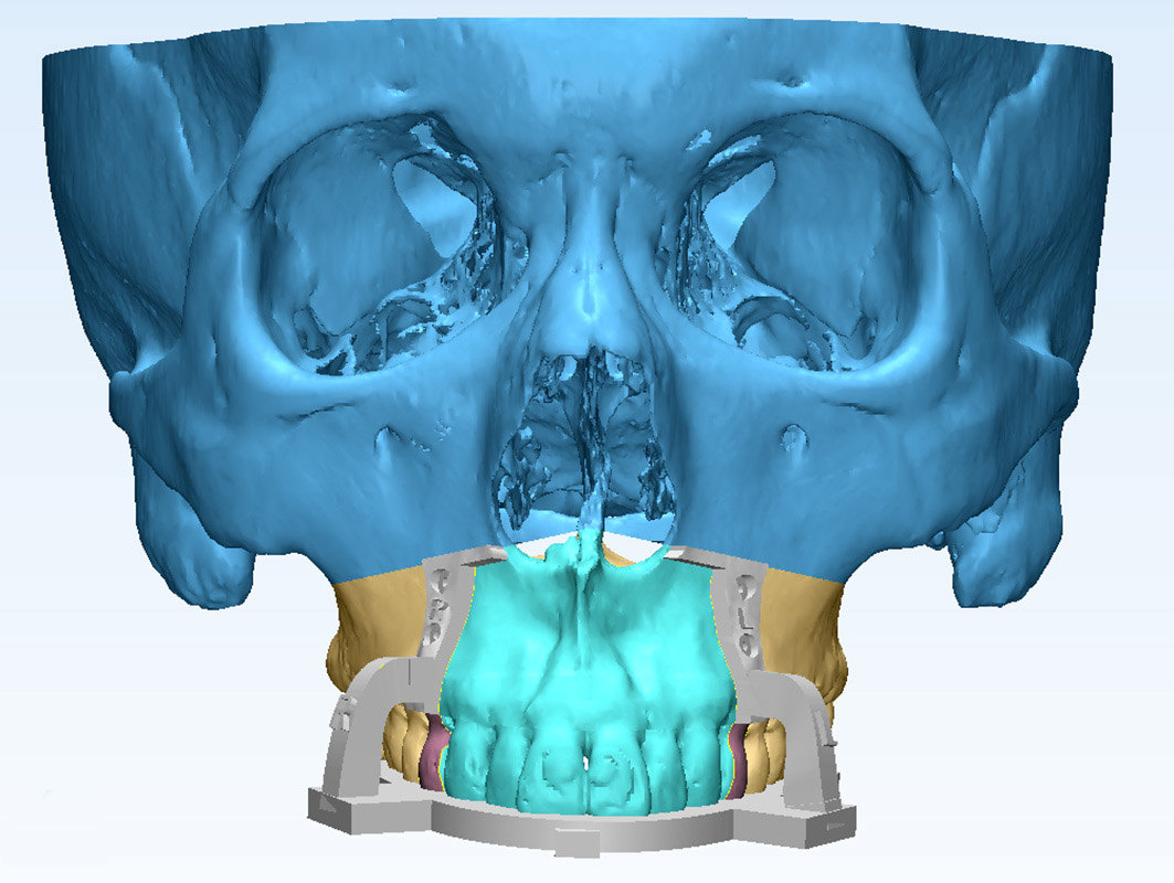 突嘴需要手术吗?