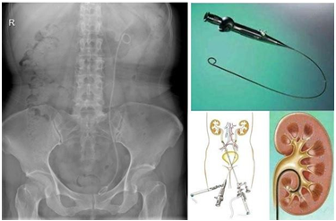 肾结石手术支架图片图片
