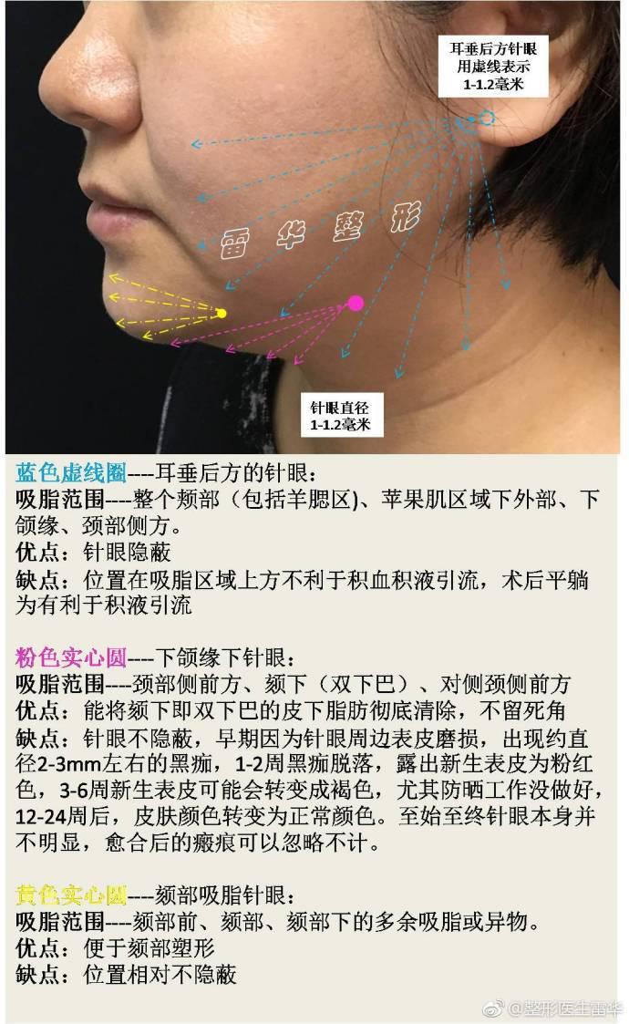 缺點:位置相對不隱蔽 面部中線旁吸脂針眼主要涉及鼻旁,淚溝,眶下區