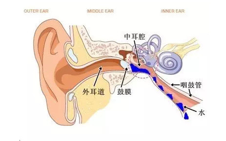 談談滲出性中耳炎