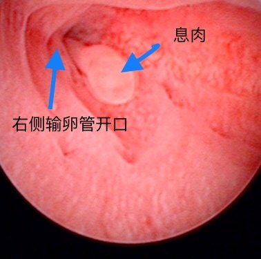 将微创进行到底宫腔镜下显微器械切除子宫内膜息肉