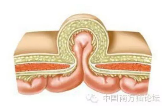 隨著傳統觀念的改善,生活質量已成為臍疝手術後最關注的焦點,但目前