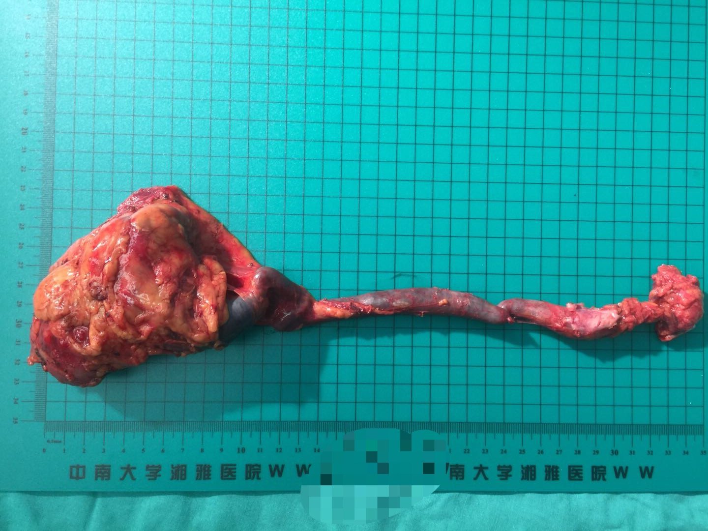 完全腹腔镜下输尿管癌,肾盂癌根治手术有更多优势,造福患者 - 好大夫