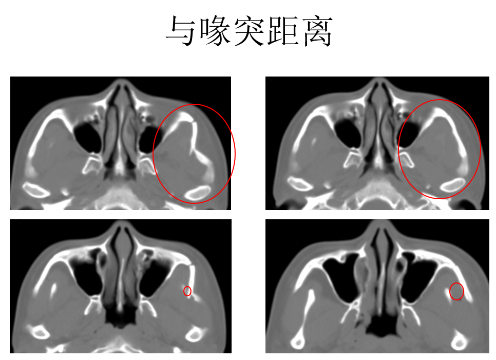 颧骨结构ct示意图-千图网