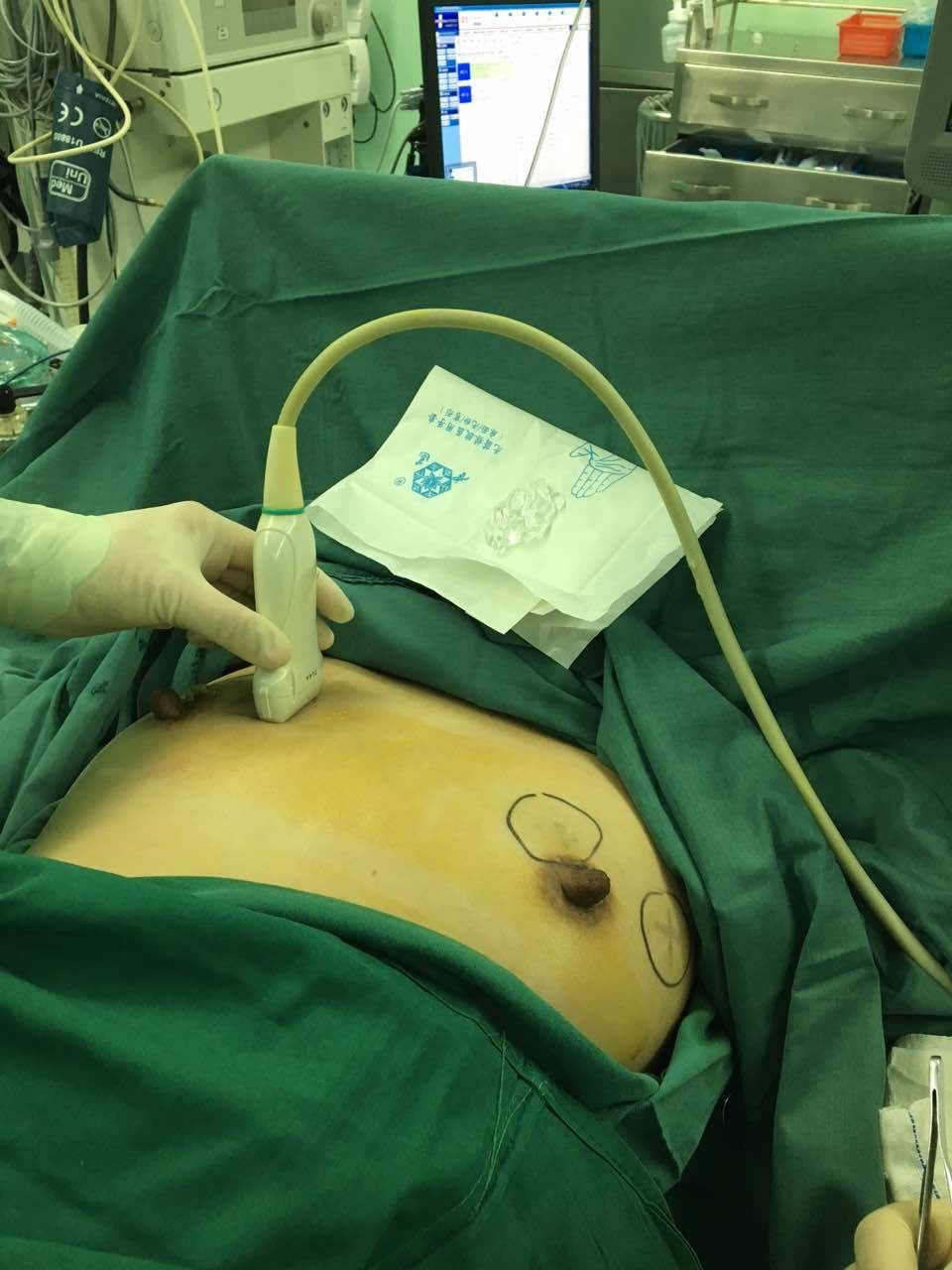 乳腺肿块手术选择微创手术好还是普通切除好