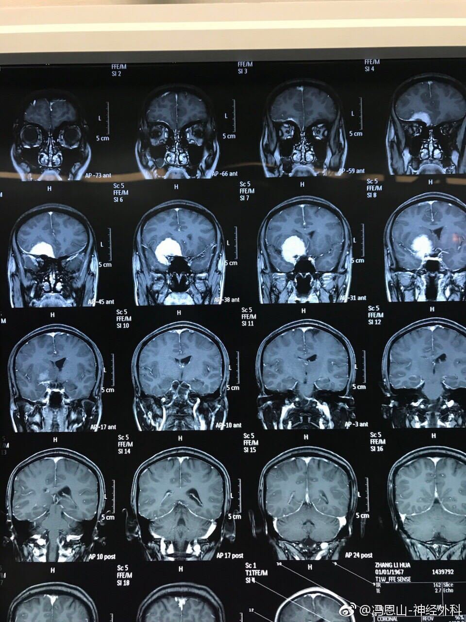蝶骨嵴脑膜瘤图片图片