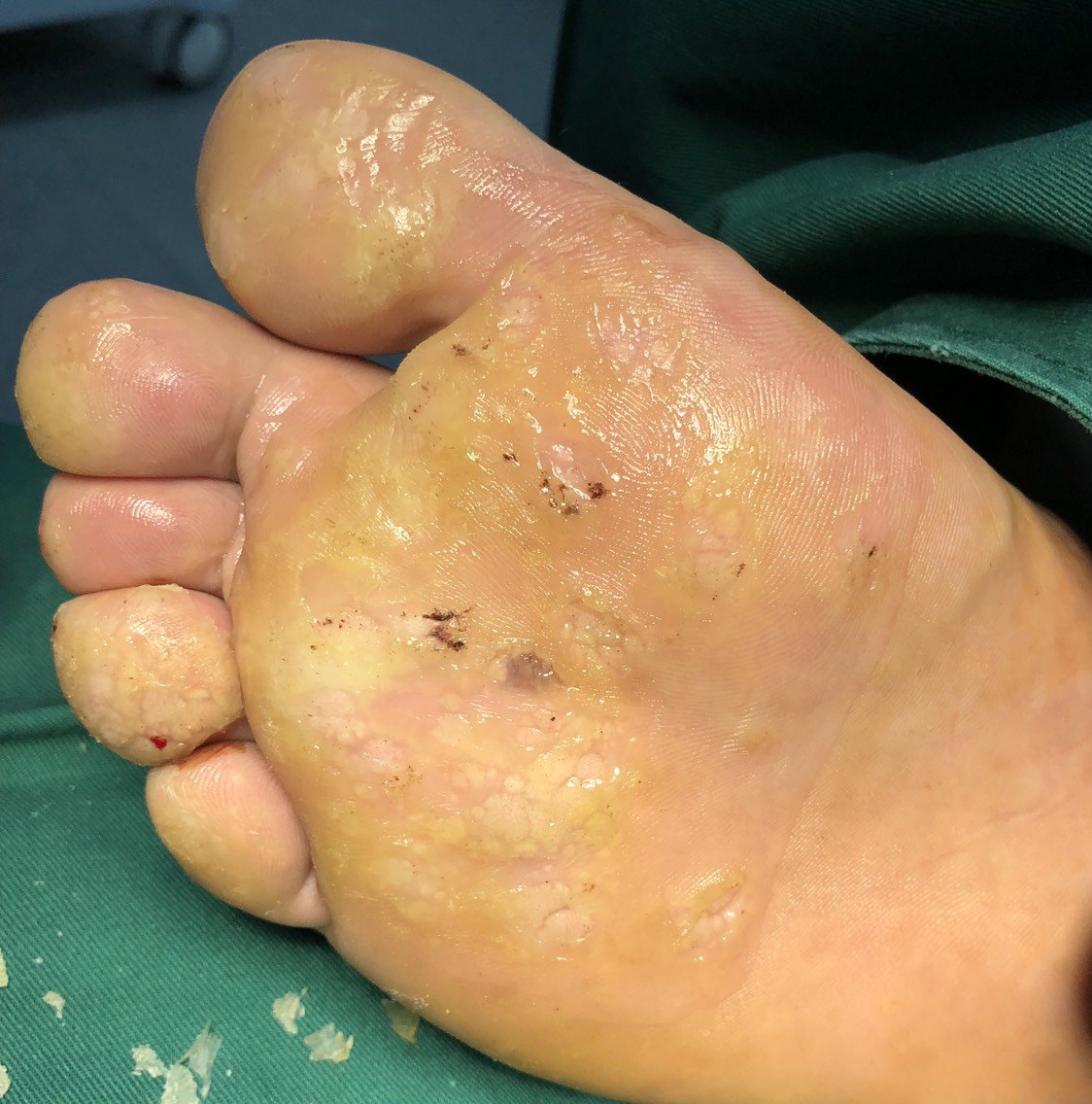 跖疣治疗(削切联合水杨酸治疗)