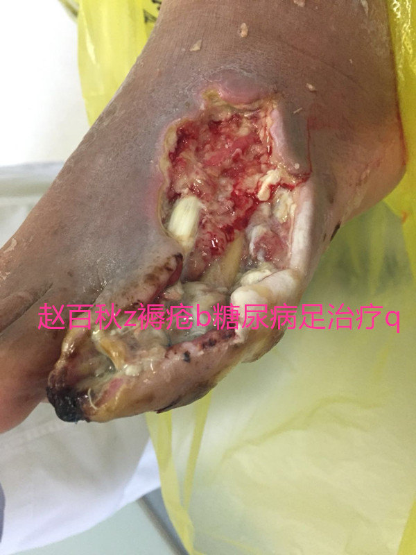 糖尿病足伴感染 骨髓炎 赵百秋 - 好大夫在线