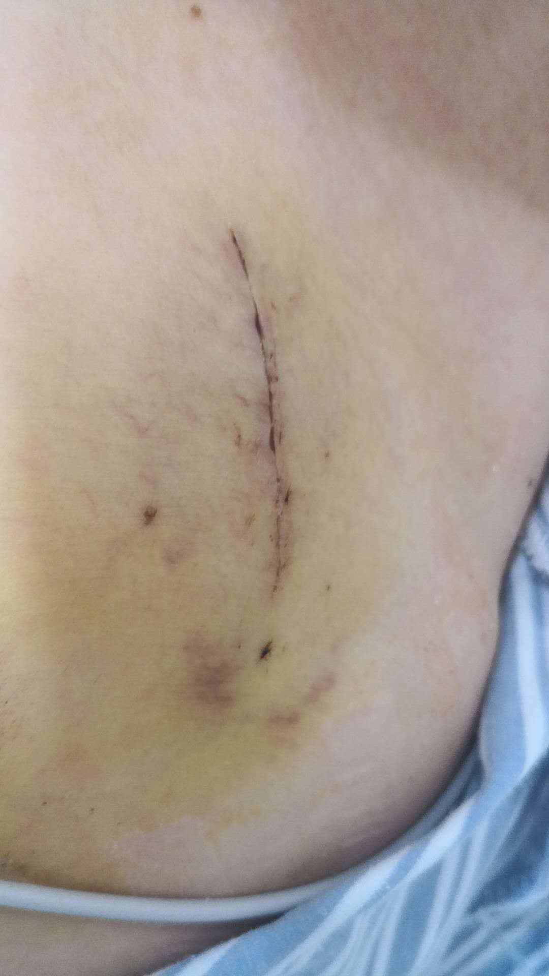 心脏支架手术疤痕图片图片