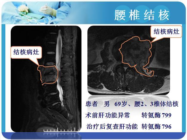 双"镜"合璧 治疗 腰椎结核(国内领先)