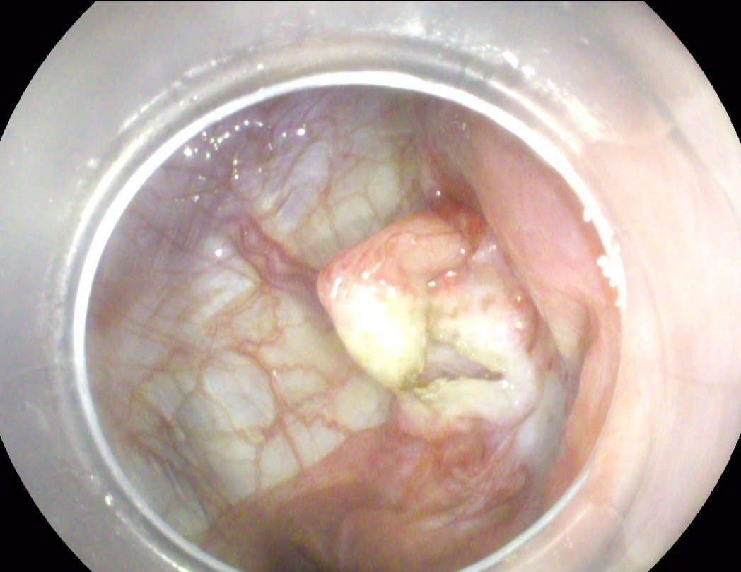 经口胃镜下肝囊肿开窗术 - 好大夫在线