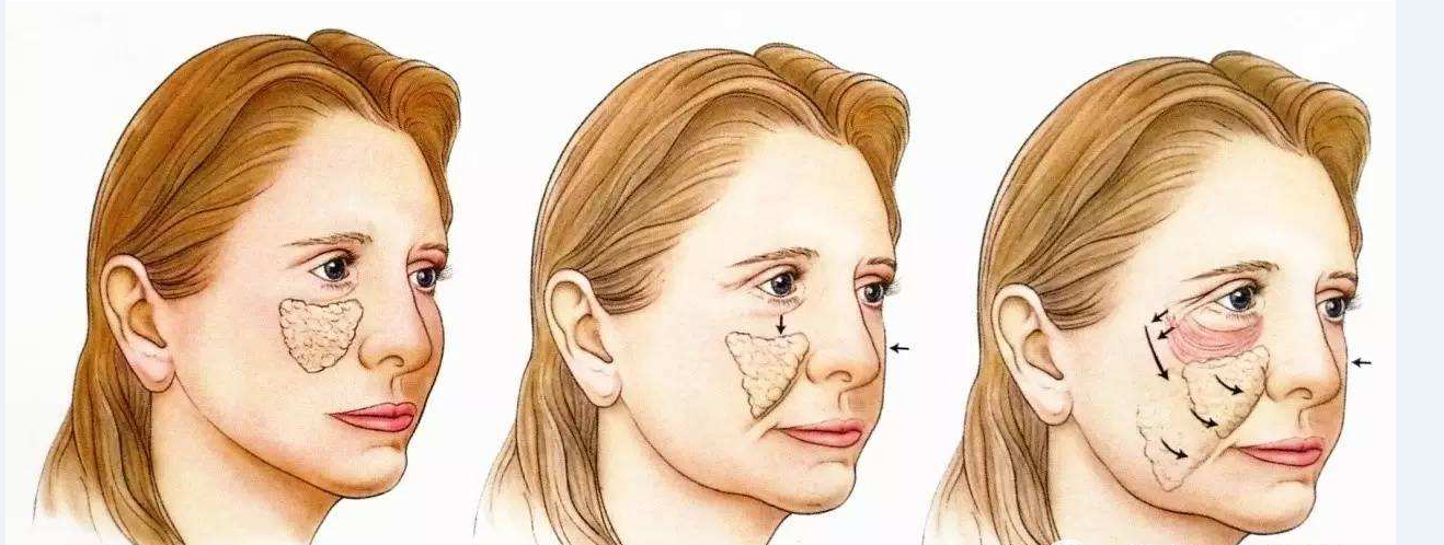 哪种微创面部提升技术比线雕更持久