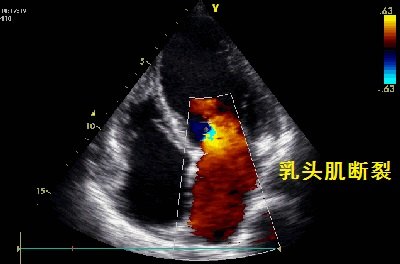 常規心臟彩超檢查主要有哪些用處