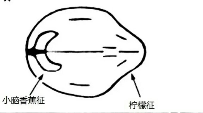 胎头柠檬征 - 好大夫在线