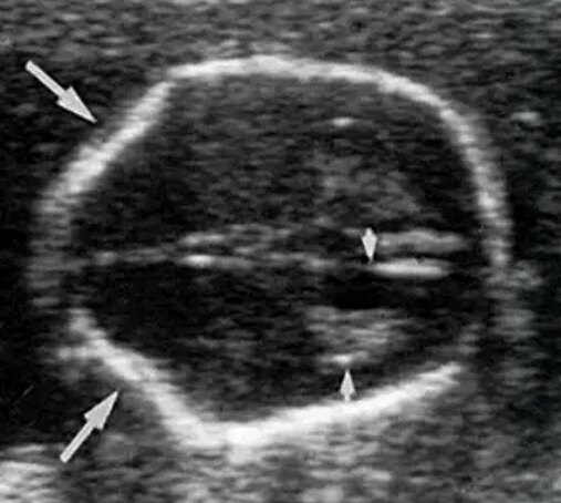 胎头柠檬征 - 好大夫在线