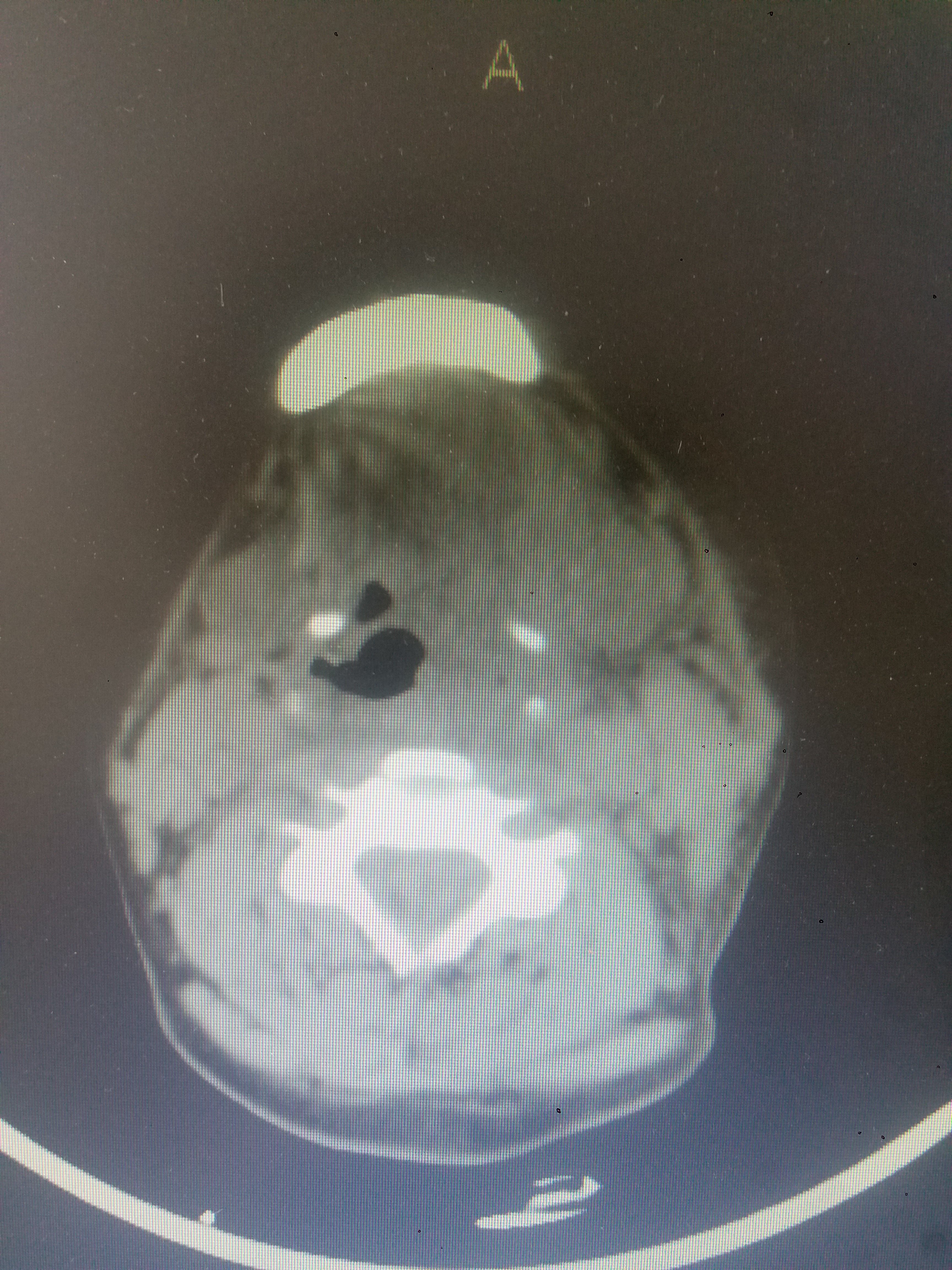 可怕的颌面颈部蜂窝组织炎 - 好大夫在线