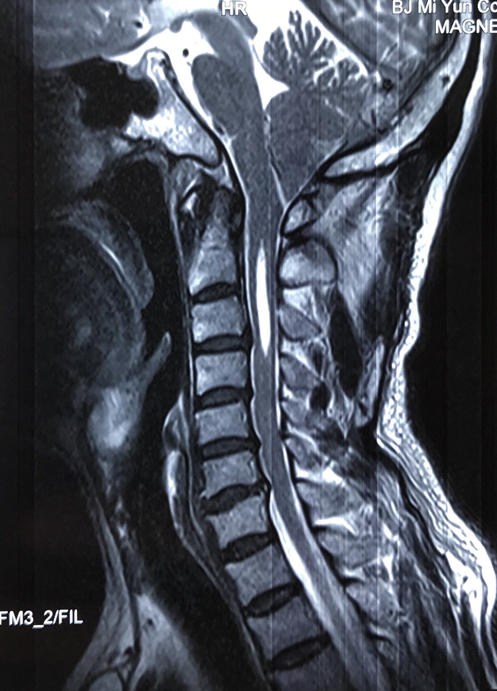 小脑扁桃体下疝合并脊髓空洞症成功治疗一例 - 好大夫在线