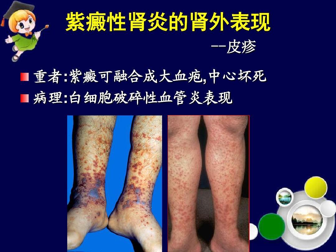 关于紫癜肾炎,这里更全面 - 好大夫在线