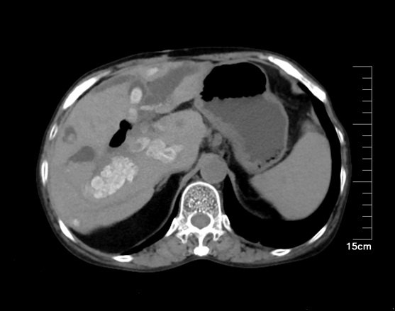 肝内胆管结石CT图片图片