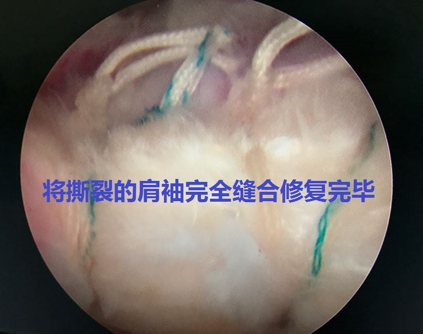 的河南省商丘市郭先生进行肩关节关节镜微创手术缝合撕裂损伤的肩袖